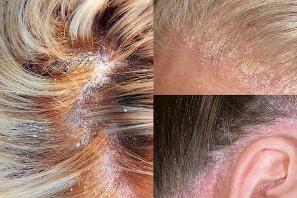Vảy nến da đầu nhẹ có thể trở nên nghiêm trọng nếu không điều trị sớm